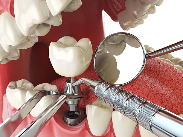 Best Emergency Broken Tooth Repair in Milford, OH